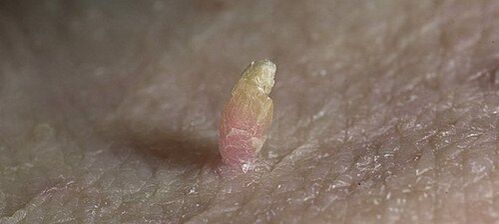 papiloma na penisu kako odstraniti