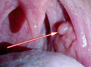 Papiloma v grlu