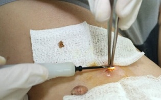 kirurško zdravljenje humanega papiloma virusa
