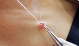 odstranjevanje papiloma na telesu z laserjem