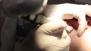Lasersko odstranjevanje papiloma na veki